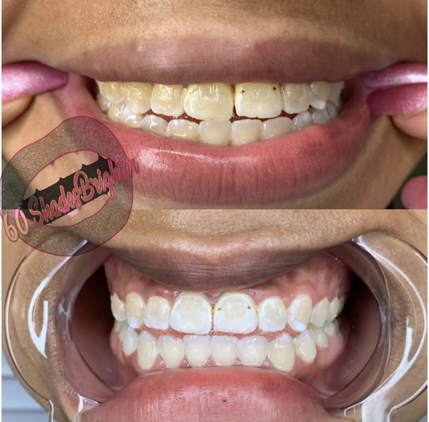 Results after ONE session !!!