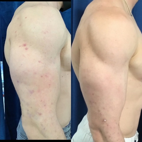 VirtueRF Needling | Elixir Aesthetics Clinic 