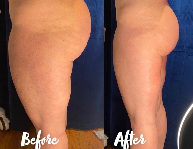 Weight Loss Therapy | Elixir Aesthetics Clinic 