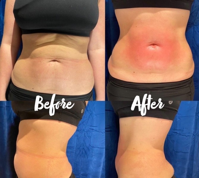 Body Contouring Treatment | Elixir Spa Denver
