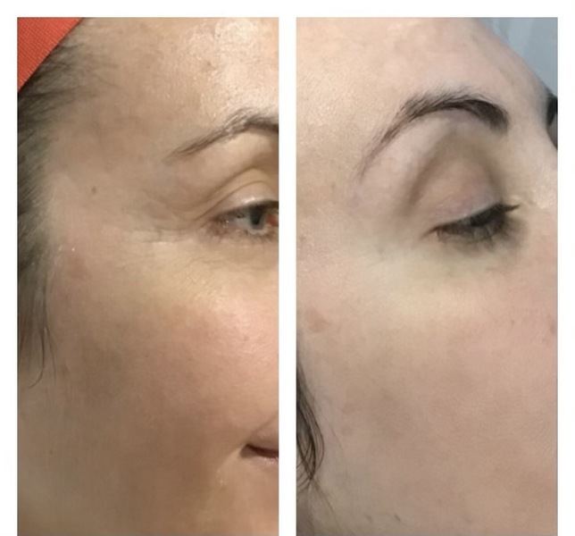 plasma facial injections before and after in Denver | IV Vitamin Therapy Denver

