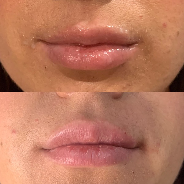 Lip Filler Therapy | Treatment Center in Denver