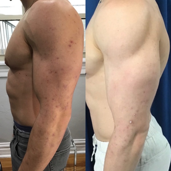 VirtueRF Needling | Elixir Aesthetics Clinic 

