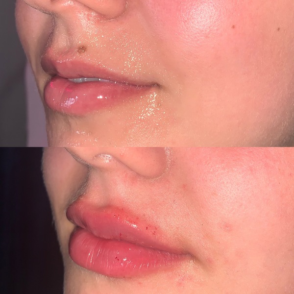 Lip Filler