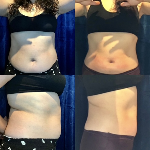 Hormone Replacement Therapy Denver | Spa Treatment Center
