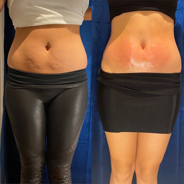Body Contouring Treatment in Denver