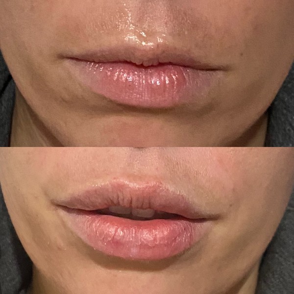 Lip Filler Therapy in Colorado | Elixir Aesthetics Clinic 