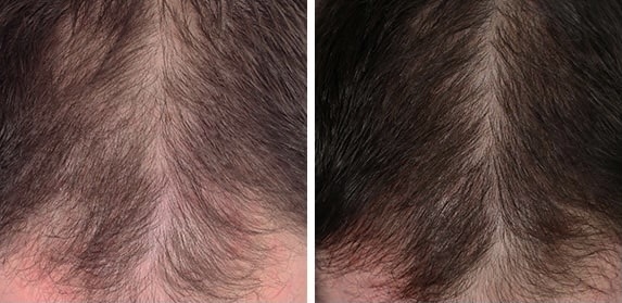 PRP Hair Restoration | Hair Treatment for Hair Loss Near Me
