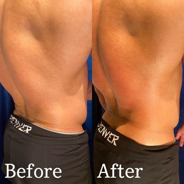 Body Contouring Clinic Denver | Elixir Aesthetics Clinic 