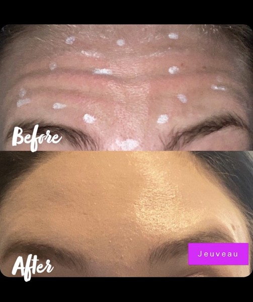 jeuveau treatment clinic | Medical Wellness Spa
