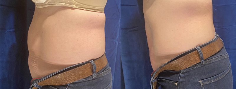 Best Body Sculpting Procedure |Body Sculpting Specialists in Denver