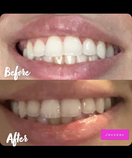 Dysport Lip Flip | Medical Wellness Services
