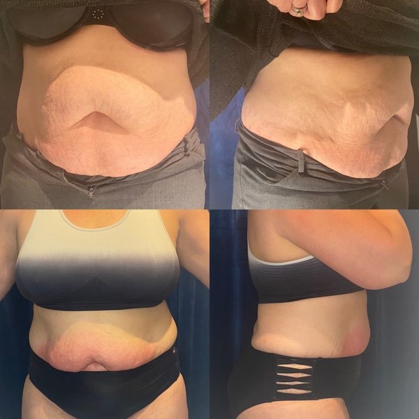 Body Contouring Weight Loss | Elixir Aesthetics Clinic 