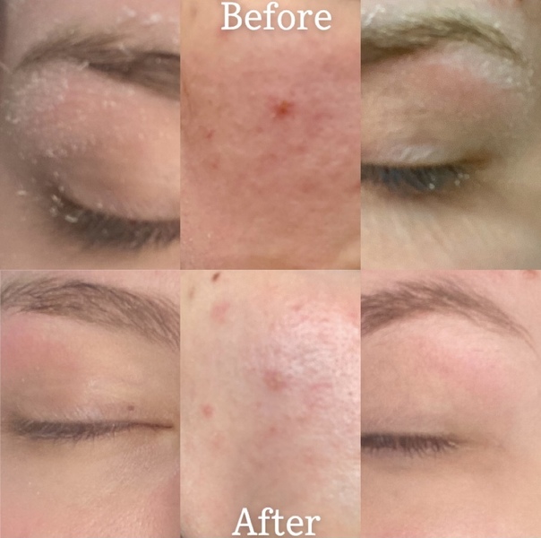 Facial |  Dermaplaning
