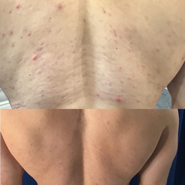 VirtueRF Needling | Elixir Aesthetics
