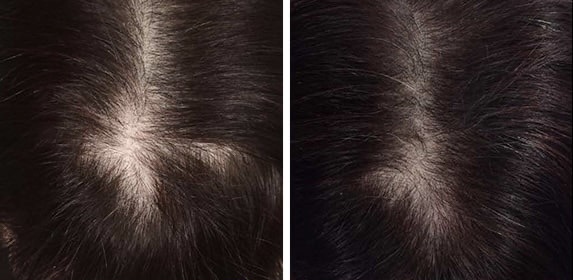 PRP Hair Restoration | Hair Restoration Treatment
