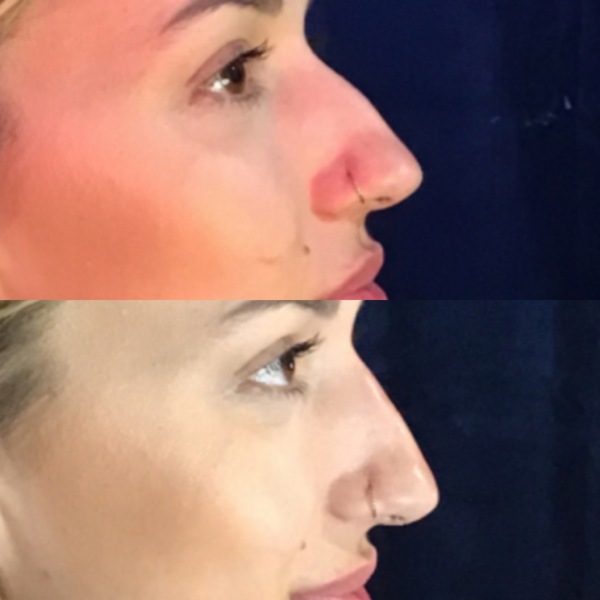 Nose Filler Therapy | Aesthetics Clinic | Skin Peeling Therapy

