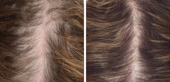 PRP Hair Restoration | Hair Restoration Treatment | Elixir Aesthetics Clinic 