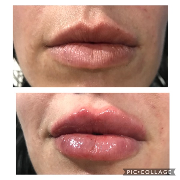 Lip Fillers Clinic in Denver | Elixir Aesthetics Clinic 
