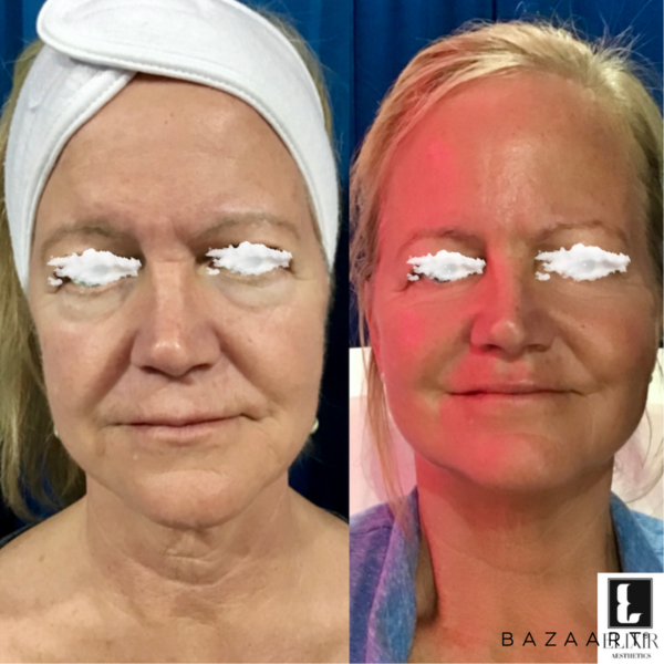 VirtueRF Facelift | Elixir Aesthetics Clinic 