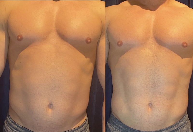 Body Contouring Treatment Denver | Medical Cosmetic Spa
