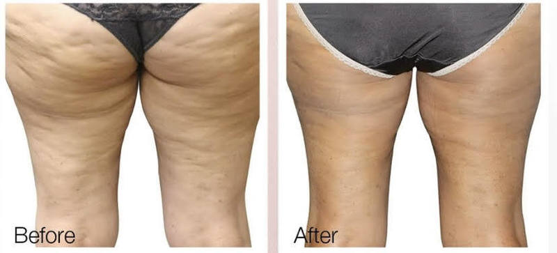 Body Contouring Treatment | skin and wellness center
