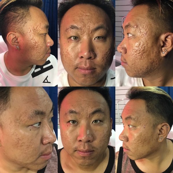 VirtueRF Needling| Elixir Aesthetics Clinic 
