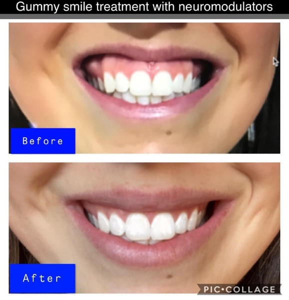 Lip Flip Botox | Botox Treatment Denver
