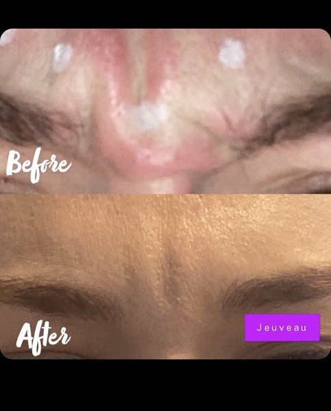 Jeuveau Wrinkle Treatment in Denver | Elixir Aesthetics Clinic 