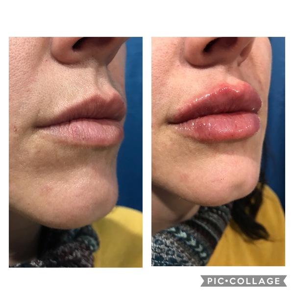 Lip Fillers Clinic | Best Place to Get Lip Injections | Elixir Aesthetics Clinic 