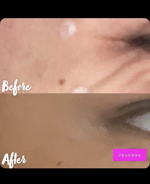 Botox Treatment Denver | Medical Wellness Services

