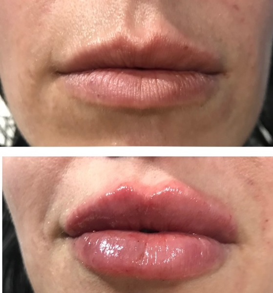 Lip Filler Treatment in Denver