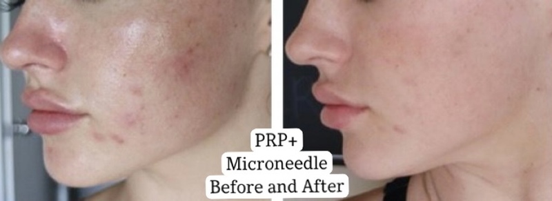 PRP Microneedle | microblading Chin in Denver
