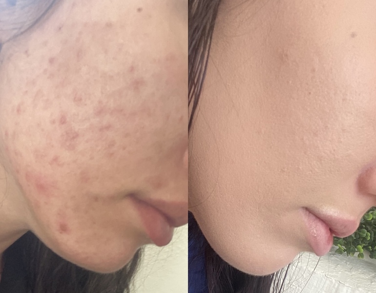 VirtueRF Therapy in Denver | Aesthetics Med Spa
