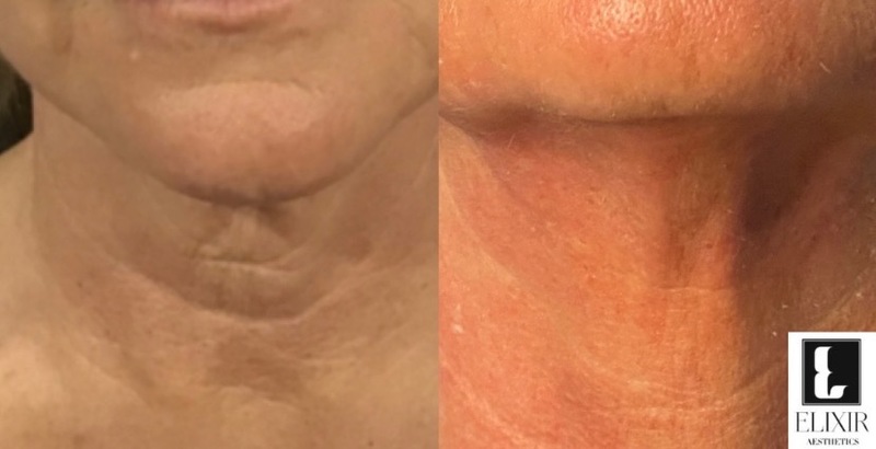 Therapy Results Neck | Nonsurgical Neck Skin Tightening
