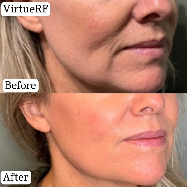 VirtueRF | Chemical Peel and Dermaplaning Center in Denver 
