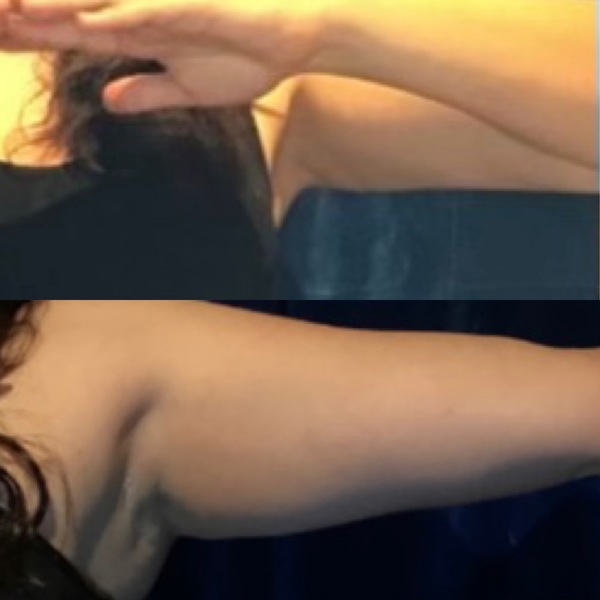 Body Contouring Treatment | Skin Peeling Therapy

