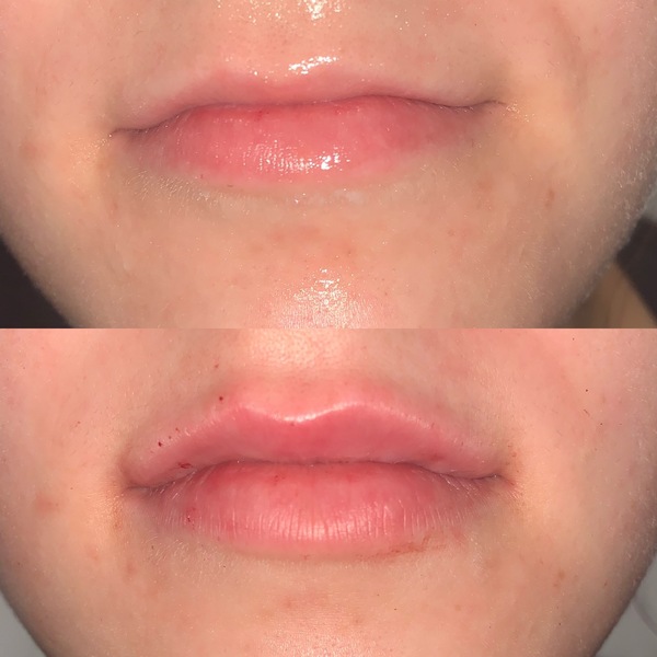 Chemical Peel and Dermaplaning | Elixir Aesthetics Clinic 