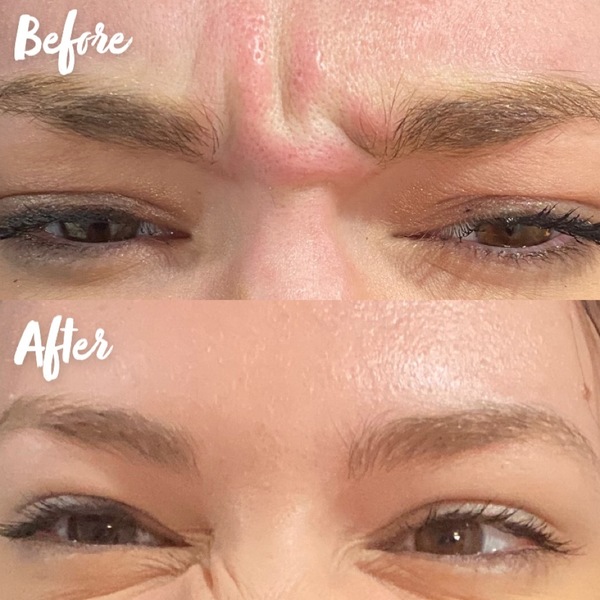 IV Vitamin Therapy Denver | Elixir Aesthetics Clinic 