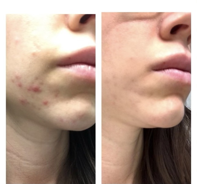 Acne Scars On Chin | Chin Lift Without Surgery | Elixir Aesthetics Clinic 

