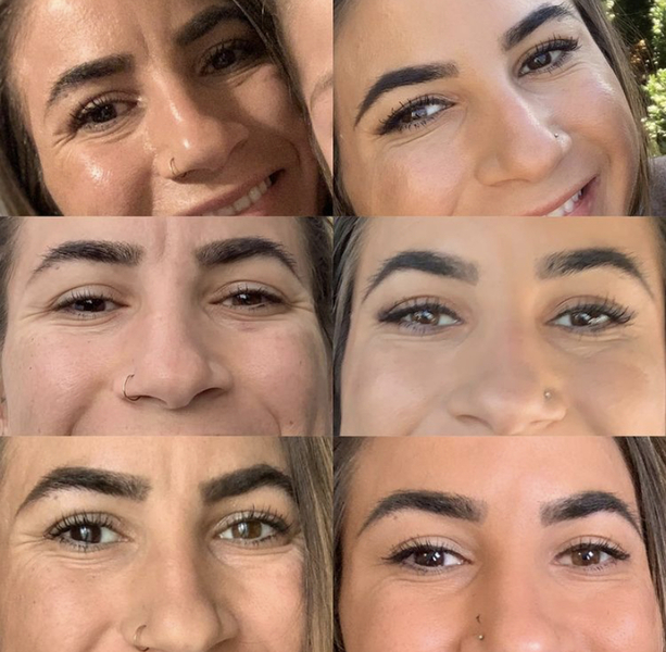 Botox Treatment Denver | Elixir Aesthetics Clinic in Colorado
