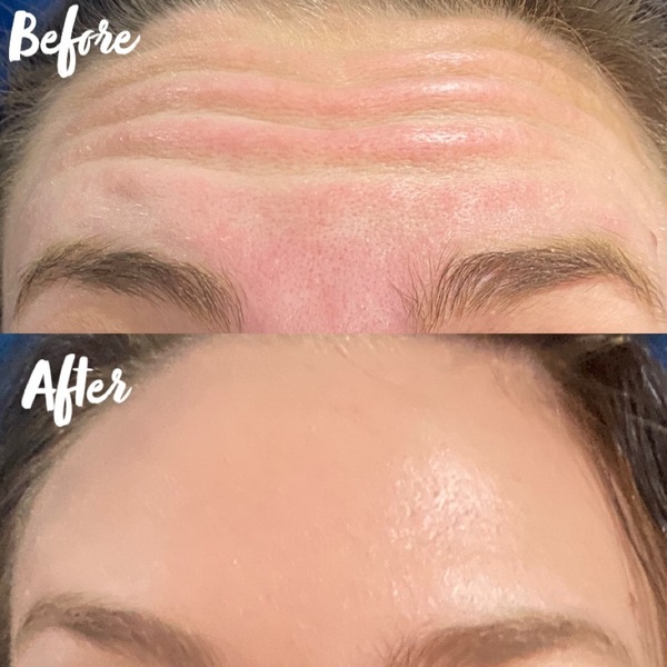 Acne Facial in Denver | Elixir Aesthetics Clinic 