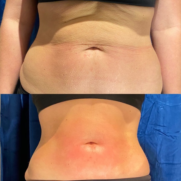 Body Contouring Therapy in Denver | Elixir Aesthetics Clinic 