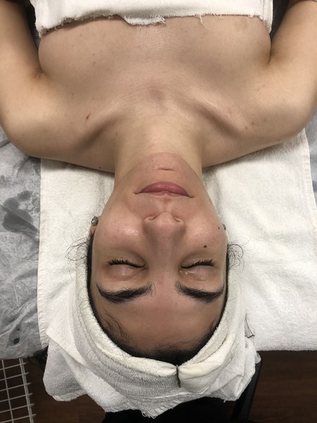 Post Facial