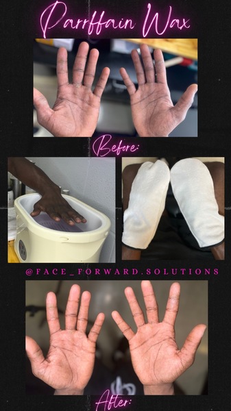 Hand Treatment; Parrffain Wax