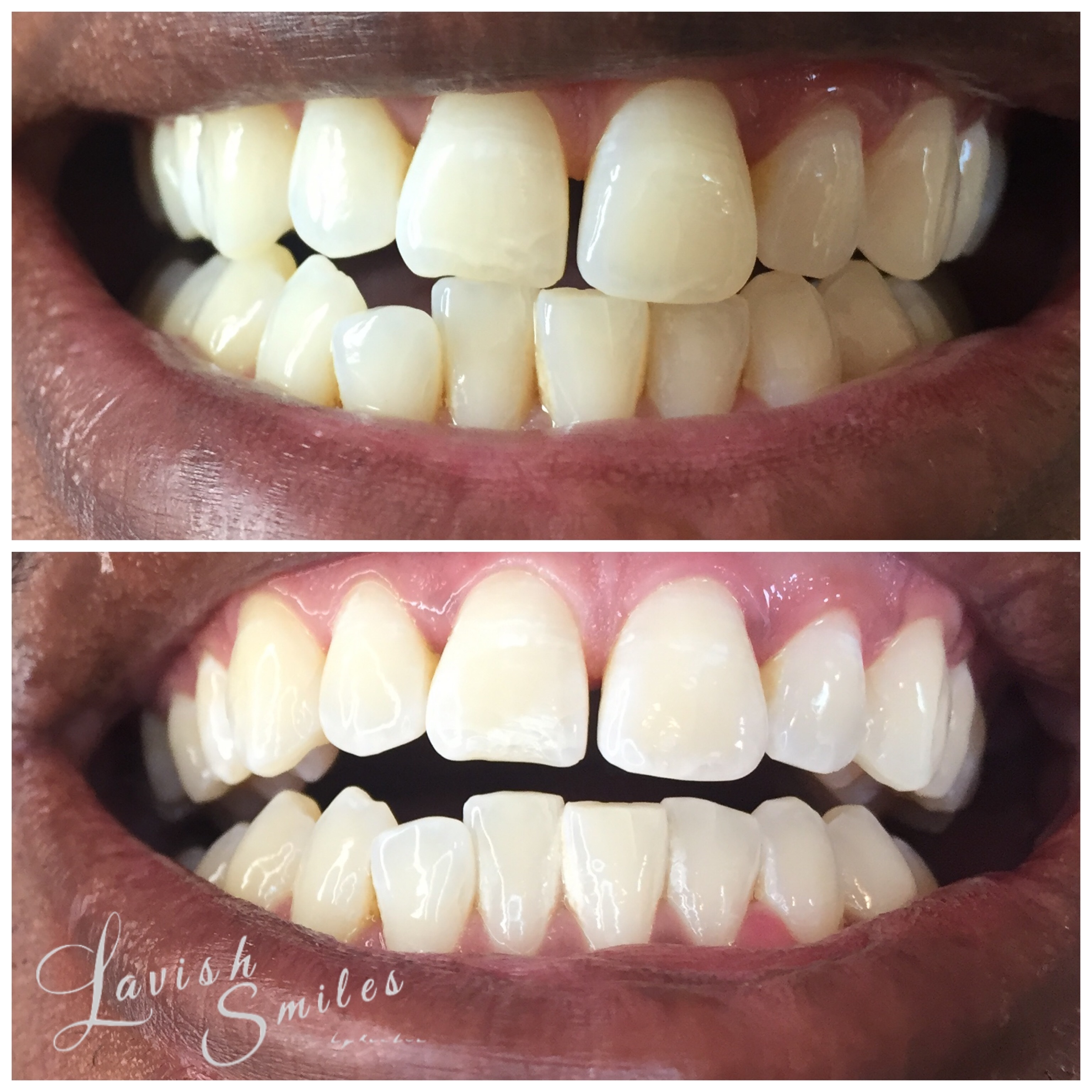 Tooth Gems & Teeth Whitening — The Lash Bar & More
